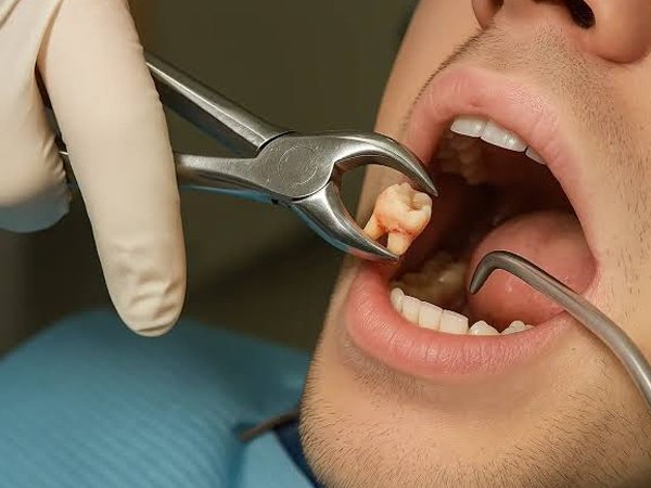 Wisdom Tooth Removal