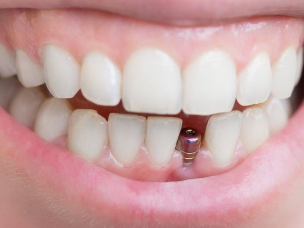 Dental Implant Surgery